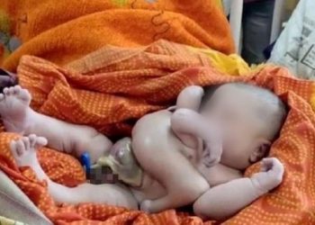Bebê com oito membros é tratado como Deus na Índia