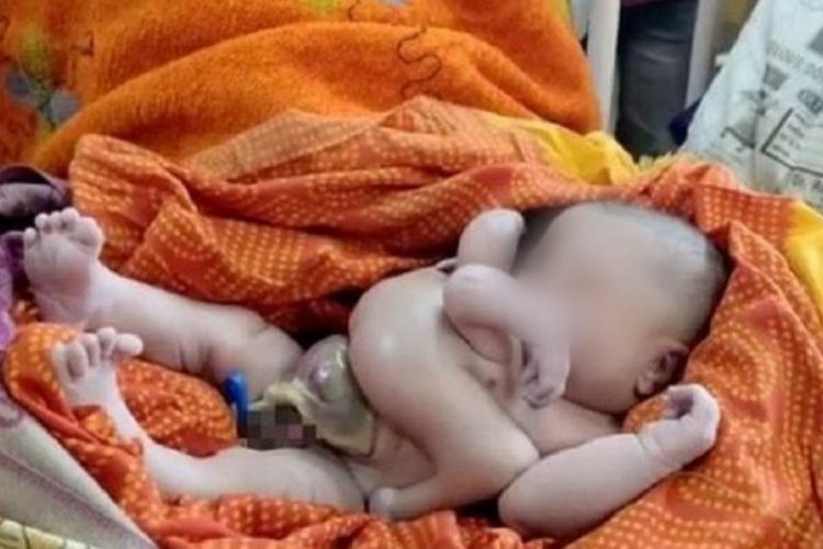 Bebê com oito membros é tratado como Deus na Índia
