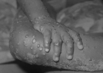 OMS alerta sobre a varíola dos macacos