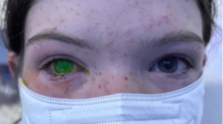 Doença do ‘olho de Natal’ causada por besouro e que provoca dor comparável à do parto ressurge na Austrália