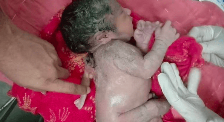 Bebê nasce com três braços na Índia