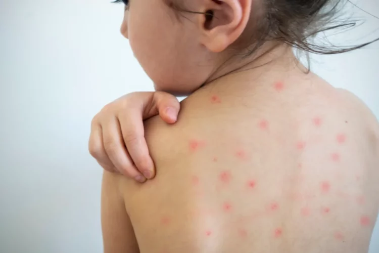 Surto de sarampo deixa Japão em alerta