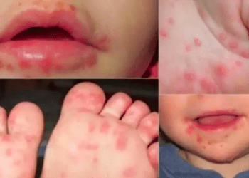 Surto de “Herpangina” em crianças na província de Gunma