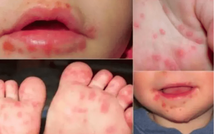 Surto de “Herpangina” em crianças na província de Gunma