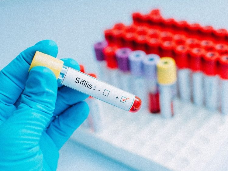Cresce o número de casos de sífilis no Japão