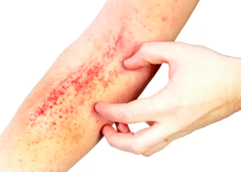 Proliferação de “Super Ácaro” gera preocupação no Japão