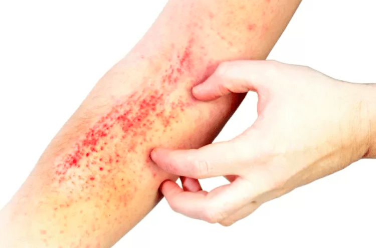 Proliferação de “Super Ácaro” gera preocupação no Japão