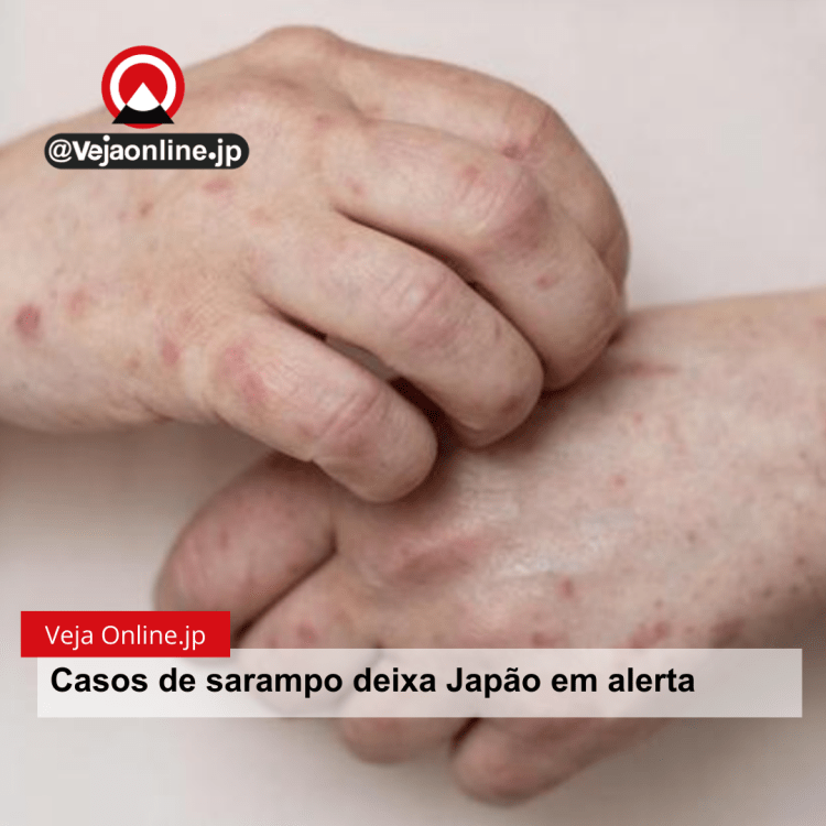 Casos de sarampo deixa Japão em alerta