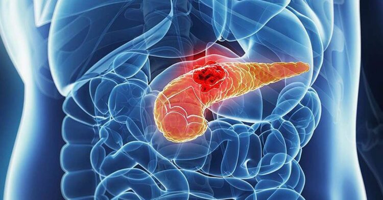 Universidade de Osaka desenvolve novo método para detectar câncer de pâncreas