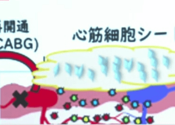 Japão pode ter primeiro tratamento com lâminas de células do coração derivadas de células iPS