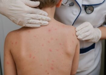 Surto de catapora deixa cidade de Kawasaki em alerta