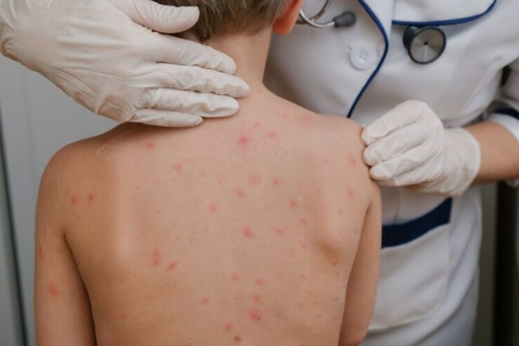 Surto de catapora deixa cidade de Kawasaki em alerta