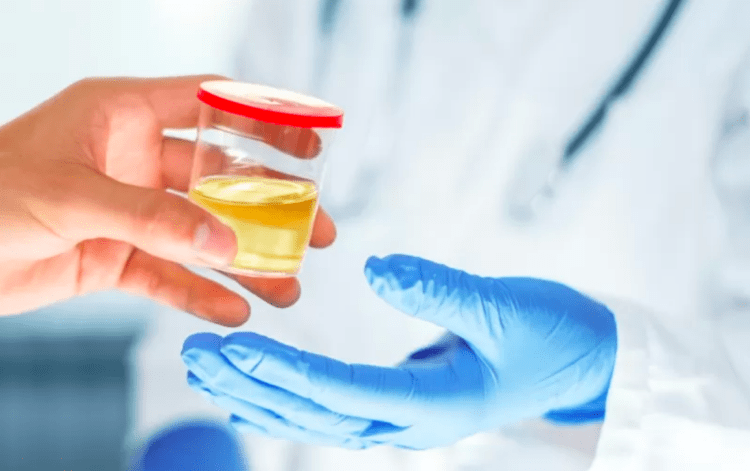 Empresa japonesa cria teste de urina para detectar câncer precoce