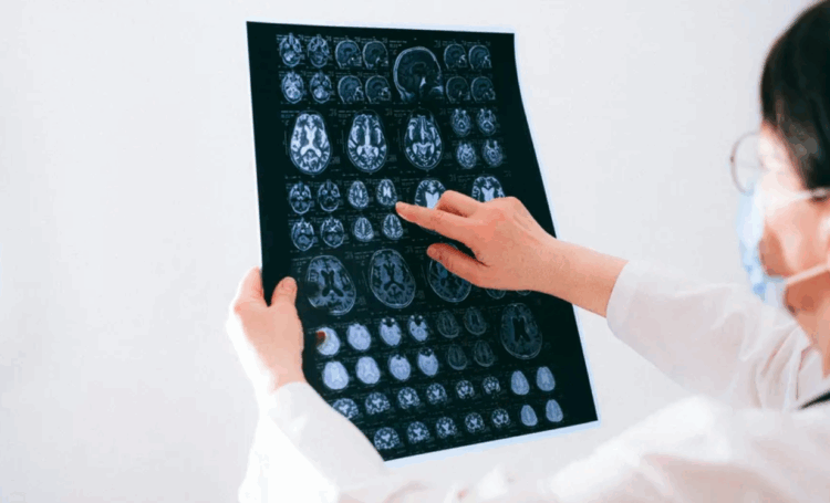 Estudo japonês identifica possível causa da “névoa cerebral” pós-Covid